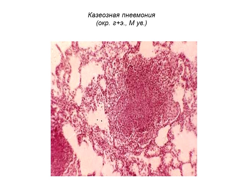 Казеозная пневмония  (окр. г+э., М ув.)